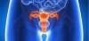 Ovarian cancer